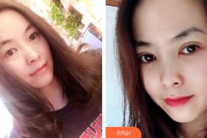 慶陽華美醫(yī)療美容診所張翰理整形價格表附切開雙眼皮案例展示