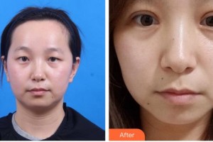 隴南市中醫(yī)醫(yī)院眼科余良智整形價格表附眼部綜合案例展示