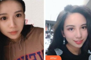 隴南市中醫(yī)醫(yī)院眼科李夫榮住院醫(yī)師整形價格表附眼部綜合案例展示