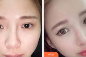 天水退休專家醫(yī)院醫(yī)療美容科焦志云整形價格表附鼻部綜合案例展示