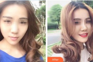 天水退休專家醫(yī)院醫(yī)療美容科何琪整形價格表附假體隆鼻案例展示