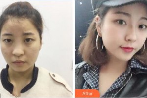 天水退休專家醫(yī)院醫(yī)療美容科魏智君整形價格表附鼻部綜合案例展示