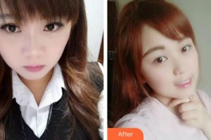 天水瑪莉亞（原女子）醫(yī)院醫(yī)學整形中心金東振整形價格表附牙齒隱形矯正案例展示