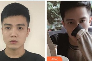 天水韓美整形美容門診部汪喜東整形價格表附埋線提升案例展示