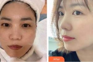 天水韓美整形美容門診部王警豫整形價格表附激光美膚激光案例展示