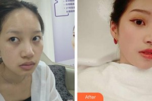 銀川鵬愛悅己醫(yī)療美容門診部羅奇整形價格表附埋線提升案例展示