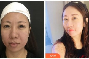 銀川慧頂醫(yī)學(xué)美容診所唐玉琴整形價格表附埋線提升案例展示