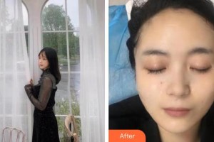 銀川慧頂醫(yī)學(xué)美容診所李鴻強整形價格表附黃金微針案例展示