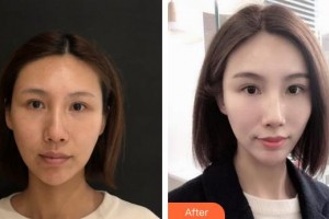 銀川靚鑫醫(yī)療美容診所張自強整形價格表附埋線提升案例展示