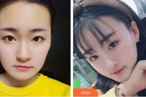 銀川維多利亞醫(yī)療美容醫(yī)院佟新玲整形價格表附埋線提升案例展示