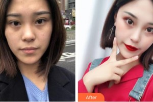 石嘴山市第二人民醫(yī)院燒傷整容中心姜娟整形價格表附清潔祛痘案例展示