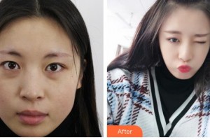 義烏愛爾眼科醫(yī)院李九可整形價(jià)格表附激光去眼袋展示