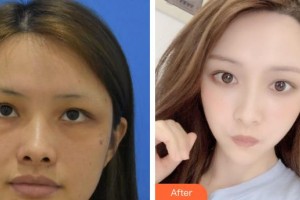 義烏視光眼科醫(yī)院賈金秀整形價(jià)格表附激光去眼袋案例展示