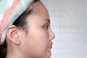 沈陽杏林美容整形醫(yī)院朱石江顴骨顴弓手術(shù)果咋樣？附果圖