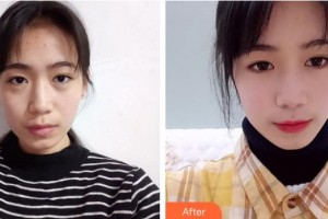 商洛中醫(yī)醫(yī)院燒傷整形科李懷善整形價(jià)格表附切開(kāi)雙眼皮案例展示