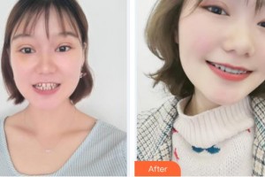 滕州時光醫(yī)療美容門診部王文科整形價格表附隱形托槽矯正案例展示