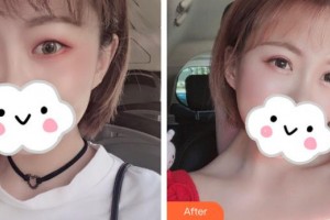 滕州市財貿(mào)醫(yī)院眼科張悅玲整形價格表附眼部綜合案例展示