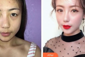 解放軍總醫(yī)院第一附屬醫(yī)院燒傷整形科柴家科整形價(jià)格表附切開雙眼皮案例展示