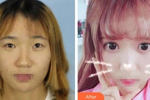 解放軍總醫(yī)院第一附屬醫(yī)院燒傷整形科盛志勇整形價(jià)格表附眼部綜合案例展示