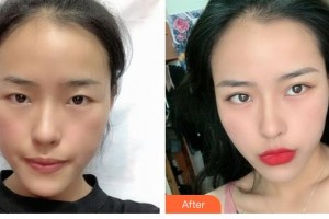 解放軍總醫(yī)院第一附屬醫(yī)院燒傷整形科京薩整形價(jià)格表附切開雙眼皮案例展示