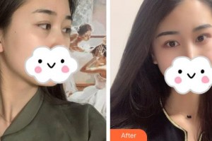 解放軍411醫(yī)院激光整形中心趙燁德整形價(jià)格表附內(nèi)切祛眼袋案例展示