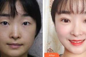 中國(guó)人民解放軍總政門診部醫(yī)學(xué)美容中心王世勇整形價(jià)格表附切開雙眼皮案例展示