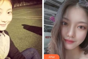 解放軍總裝備部后勤部醫(yī)學(xué)整形中心張殿祥整形價(jià)格表附開內(nèi)眼角案例展示