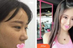 解放軍第一五八醫(yī)院整形美容中心張照日整形價(jià)格表附埋線提升案例展示