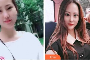 解放軍421醫(yī)院整形美容中心劉春利整形價(jià)格表附熱拉提案例展示