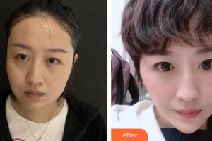 解放軍421醫(yī)院整形美容中心李新莉整形價(jià)格表附埋線提升案例展示