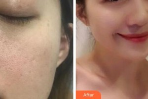 解放軍總醫(yī)院第一附屬醫(yī)院燒傷整形科李峰整形價(jià)格表附埋線提升案例展示