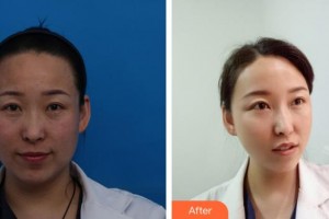 解放軍總醫(yī)院第一附屬醫(yī)院燒傷整形科賈曉明整形價(jià)格表附埋線提升案例展示