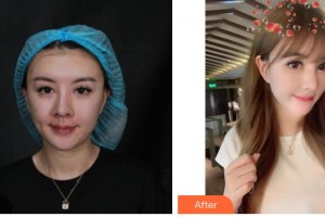 解放軍307醫(yī)院整形燒傷科楊志祥整形價(jià)格表附埋線提升案例展示