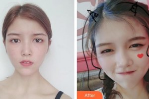 解放軍總醫(yī)院第一附屬醫(yī)院燒傷整形科許明火整形價(jià)格表附熱瑪吉案例展示