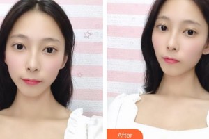 解放軍422醫(yī)院醫(yī)學(xué)整形美容中心鄭圣謨整形價(jià)格表附埋線提升案例展示