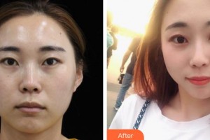 解放軍421醫(yī)院整形美容中心趙莉整形價(jià)格表附埋線提升案例展示