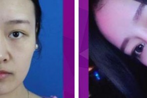 解放軍總醫(yī)院第一附屬醫(yī)院燒傷整形科賈赤宇整形價(jià)格表附鼻部綜合案例展示