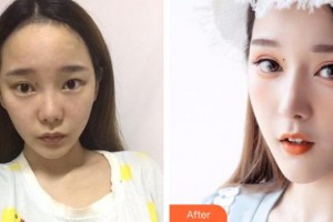 解放軍總醫(yī)院第一附屬醫(yī)院燒傷整形科宋慧鋒整形價(jià)格表附假體隆鼻案例展示