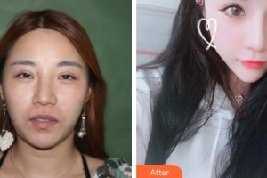 解放軍第三〇三醫(yī)院燒傷整形美容外科楊家驥整形價(jià)格表附鼻部綜合案例展示