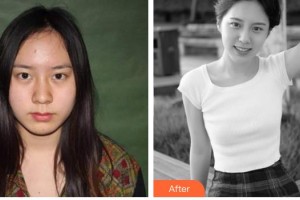 解放軍第三〇三醫(yī)院燒傷整形美容外科黃震亞整形價(jià)格表附鼻部綜合案例展示