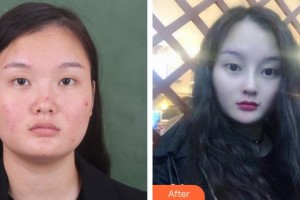 解放軍第一五八醫(yī)院整形美容中心刁樹信整形價(jià)格表附鼻部綜合案例展示