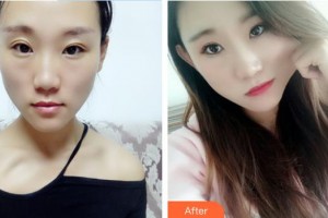 解放軍總醫(yī)院第一附屬醫(yī)院燒傷整形科申傳安整形價(jià)格表附硅膠隆鼻案例展示