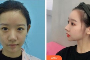 中國(guó)人民解放軍251醫(yī)院整形美容科阮仕榮整形價(jià)格表附鼻部綜合案例展示