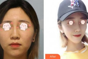 解放軍第159醫(yī)院燒傷整形美容康復(fù)中心林國(guó)安整形價(jià)格表附鼻部綜合案例展示