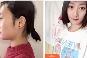 解放軍總醫(yī)院第一附屬醫(yī)院燒傷整形科朱兆明整形價(jià)格表附假體隆鼻案例展示