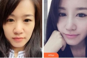 中國人民解放軍第一六三醫(yī)院整形美容中心吳丙整形價(jià)格表附硅膠隆鼻案例展示