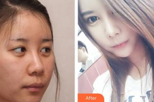 中國人民解放軍第一六三醫(yī)院整形美容中心易文林整形價(jià)格表附膨體隆鼻案例展示