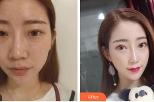 中國人民解放軍第五十九中心醫(yī)院燒傷整形科潘文東整形價(jià)格表附膨體隆鼻案例展示