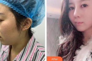 中國人民解放軍193醫(yī)院整形外科陳立整形價(jià)格表附耳軟骨復(fù)合隆鼻案例展示