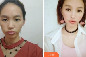 解放軍第一五八醫(yī)院整形美容中心廖柳整形價(jià)格表附鼻部綜合案例展示